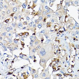 Immunohistochemistry analysis of paraffin-embedded human lung cancer using Anti-IGF1 Antibody (A11137) at a dilution of 1:100 (40x lens) Perform high pressure antigen retrieval with 10 mM citrate buffer pH 60 before commencing with IHC staining protocol