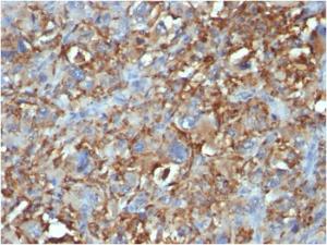 Immunohistochemical analysis of formalin-fixed, paraffin-embedded human histiocytoma using Anti-CD68 Antibody [C68/684]