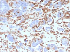 Immunohistochemical analysis of formalin-fixed, paraffin-embedded human colon carcinoma using Anti-Vimentin Antibody [VIM/3736]