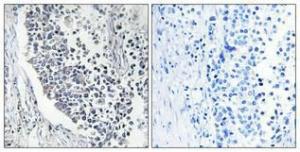 Immunohistochemical analysis of paraffin-embedded human lung cancer using Anti-AIFM2 Antibody 1:100 (4°C overnight). The right hand panel represents a negative control, where the antibody was pre-incubated with the immunising peptide