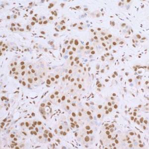 Immunohistochemistry analysis of formalin-fixed, paraffin-embedded human breast carcinoma section labelling SP1 with Anti-SP1 Antibody (A295285), at a 1:5,000 dilution