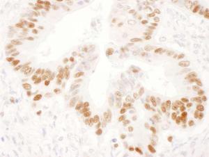 Immunohistochemistry analysis of formalin-fixed, paraffin-embedded human stomach carcinoma section labelling p53 with Anti-p53 Antibody [Clone DO-1], at a 1:100 dilution