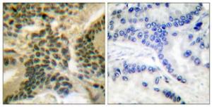 Immunohistochemical analysis of paraffin-embedded human lung carcinoma using Anti-PKC zeta (phospho Thr410) Antibody. The right hand panel represents a negative control, where the antibody was pre-incubated with the immunising peptide