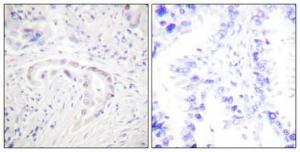 Immunohistochemical analysis of paraffin-embedded human lung cancer using Anti-PKC zeta (phospho Thr410) Antibody 1:100 (4°C overnight). The right hand panel represents a negative control, where the antibody was pre-incubated with the immunising peptide