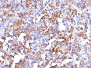 Immunohistochemical analysis of formalin-fixed, paraffin-embedded human histiocytoma using Anti-CD68 Antibody [LAMP4/824]