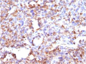 Immunohistochemical analysis of formalin-fixed, paraffin-embedded human histiocytoma using Anti-CD68 Antibody [CD68/G2]