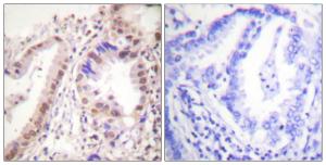 Immunohistochemical analysis of paraffin-embedded human lung carcinoma tissue using Anti-Estrogen Receptor-alpha Antibody. The right hand panel represents a negative control, where the antibody was pre-incubated with the immunising peptide