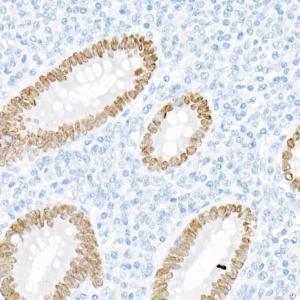 Immunohistochemistry analysis of paraffin-embedded human appendix tissue using Anti-SATB2 Antibody [ARC2363] (A308738) at a dilution of 1:100 (40X lens). Perform high pressure antigen retrieval with 10 mM citrate buffer pH 6.0 before commencing with IHC staining protocol