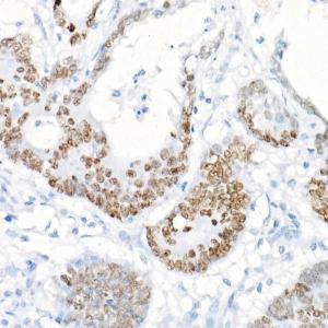 Immunohistochemistry analysis of paraffin-embedded human colon carcinoma tissue using Anti-SATB2 Antibody [ARC2363] (A308738) at a dilution of 1:100 (40X lens). Perform high pressure antigen retrieval with 10 mM citrate buffer pH 6.0 before commencing with IHC staining protocol