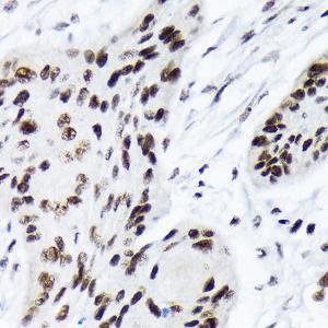 Immunohistochemistry analysis of paraffin-embedded human esophageal cancer using Anti-ARID1A Antibody [ARC2177] (A308739) at a dilution of 1:100 (40X lens). Perform microwave antigen retrieval with 10 mM Tris/EDTA buffer pH 9.0 before commencing with IHC staining protocol