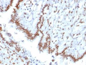 Immunohistochemical analysis of formalin-fixed, paraffin-embedded human endometrial carcinoma using Anti-TLE1 Antibody [TLE1/2085]