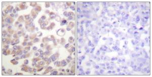 Immunohistochemical analysis of paraffin-embedded human breast carcinoma tissue using Anti-WNT1 Antibody. The right hand panel represents a negative control, where the antibody was pre-incubated with the immunising peptide