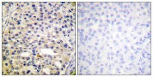 Immunohistochemical analysis of paraffin-embedded human breast carcinoma using Anti-Vimentin (phospho Ser56) Antibody. The right hand panel represents a negative control, where the antibody was pre-incubated with the immunising peptide.