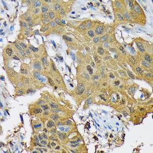 Immunohistochemistry analysis of paraffin-embedded human lung cancer using Anti-RPB3 Antibody [ARC1729] (A307655) at a dilution of 1:100 (40X lens). Perform microwave antigen retrieval with 10 mM Tris/EDTA buffer pH 9.0 before commencing with IHC staining protocol