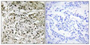 Immunohistochemical analysis of paraffin-embedded human breast carcinoma tissue using Anti-TAF1 Antibody. The right hand panel represents a negative control, where the antibody was pre-incubated with the immunising peptide.