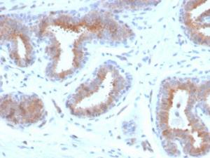 Immunohistochemical analysis of formalin-fixed, paraffin-embedded human breast carcinoma using Anti-Mammaglobin A Antibody [rMGB/4299]