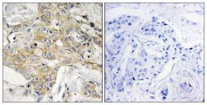 Immunohistochemical analysis of paraffin-embedded human breast carcinoma tissue using Anti-T4S1 Antibody. The right hand panel represents a negative control, where the antibody was pre-incubated with the immunising peptide.