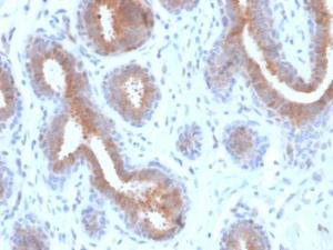 Immunohistochemical analysis of formalin-fixed, paraffin-embedded human breast carcinoma using Anti-Mammaglobin A Antibody [rMGB/4299]