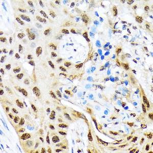 Immunohistochemistry analysis of paraffin-embedded human lung cancer using Anti-HES5 Antibody [ARC1740] (A308760) at a dilution of 1:100 (40x lens). Perform microwave antigen retrieval with 10 mM Tris/EDTA buffer pH 9.0 before commencing with IHC staining protocol.