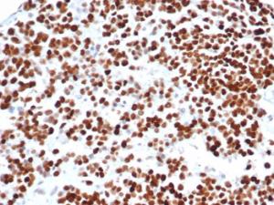 Immunohistochemical analysis of formalin-fixed, paraffin-embedded human serous ovarian carcinoma tissue using Anti-p53 Antibody [rTP53/6927]