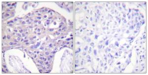 Immunohistochemical analysis of paraffin-embedded human breast carcinoma tissue using Anti-FOXO1 + FOXO3 + FOXO4 Antibody. The right hand panel represents a negative control, where the Antibody was pre-incubated with the immunising peptide