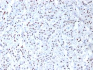 Immunohistochemical analysis of formalin-fixed, paraffin-embedded human mesothelioma using Anti-Wilms tumor Protein Antibody [6F-H2]