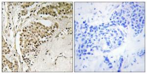 Immunohistochemical analysis of paraffin-embedded human breast carcinoma tissue using Anti-NOM1 Antibody. The right hand panel represents a negative control, where the antibody was pre-incubated with the immunising peptide