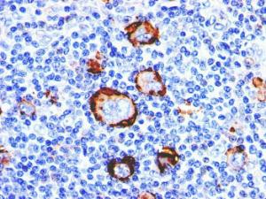 Immunohistochemical analysis of formalin-fixed, paraffin-embedded human Hodgkin's lymphoma using Anti-CD15 Antibody [Leu-M1]