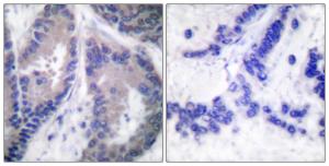 Immunohistochemical analysis of paraffin-embedded human lung carcinoma tissue using Anti-Collagen alpha1 XVIII Antibody. The right hand panel represents a negative control, where the antibody was pre-incubated with the immunising peptide