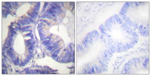 Immunohistochemical analysis of paraffin-embedded human colon carcinoma tissue using Anti-NCK2 Antibody. The right hand panel represents a negative control, where the antibody was pre-incubated with the immunising peptide