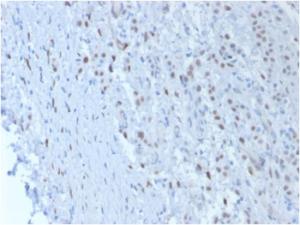 Immunohistochemical analysis of formalin-fixed, paraffin-embedded human mesothelioma using Anti-Wilms tumor Protein Antibody [SPM361]