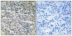 Immunohistochemical analysis of paraffin-embedded human prostate carcinoma tissue using Anti-MP68 Antibody. The right hand panel represents a negative control, where the antibody was pre-incubated with the immunising peptide.