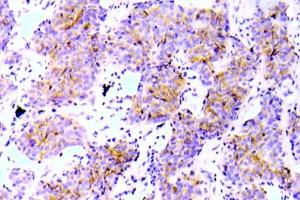 Immunohistochemical analysis of paraffin-embedded human lung adenocarcinoma tissue using Anti-ALK (phospho Tyr1586) Antibody