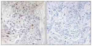 Immunohistochemical analysis of paraffin-embedded human breast carcinoma tissue using Anti-MAFF Antibody. The right hand panel represents a negative control, where the antibody was pre-incubated with the immunising peptide.