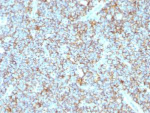 Immunohistochemical analysis of formalin-fixed, paraffin-embedded human Ewing's sarcoma using Anti-CD99 Antibody [MIC2/1495R]