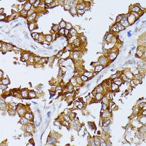 Immunohistochemistry analysis of paraffin-embedded human lung cancer using Anti-SEPT4 Antibody (A11271) at a dilution of 1:100 (40X lens). Perform microwave antigen retrieval with 10 mM PBS buffer pH 7.2 before commencing with IHC staining protocol