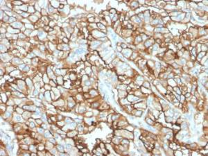 Immunohistochemical analysis of formalin-fixed, paraffin-embedded human renal cell carcinoma using Anti-CD10 Antibody [MME/1870]