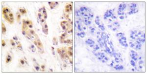 Immunohistochemical analysis of paraffin-embedded human breast carcinoma using Anti-SSB (phospho Ser366) Antibody. The right hand panel represents a negative control, where the antibody was pre-incubated with the immunising peptide