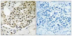 Immunohistochemical analysis of paraffin-embedded human breast cancer using Anti-SSB (phospho Ser366) Antibody 1:100 (4 °C overnight). The right hand panel represents a negative control, where the antibody was pre-incubated with the immunising peptide