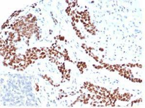 Immunohistochemical analysis of formalin-fixed, paraffin-embedded human ovarian carcinoma tissue using Anti-Wilms Tumor Protein Antibody [rWT1/6908]. Inset: PBS instead of the primary antibody. Secondary antibody negative control