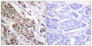 Immunohistochemical analysis of paraffin-embedded human breast carcinoma using Anti-p53 (phospho Ser392) Antibody. The right hand panel represents a negative control, where the antibody was pre-incubated with the immunising peptide.