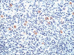 Immunohistochemical analysis of formalin-fixed, paraffin-embedded human Hodgkin's lymphoma using Anti-CD15 Antibody [SPM490]