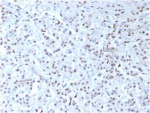 Immunohistochemical analysis of formalin-fixed, paraffin-embedded human mesothelioma using Anti-Wilms tumor Protein Antibody [rWT1/857]