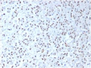 Immunohistochemical analysis of formalin-fixed, paraffin-embedded human mesothelioma using Anti-Wilms tumor Protein Antibody [WT1/1434R]