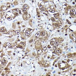 Immunohistochemistry analysis of paraffin-embedded human liver cancer using Anti-Ubiquitin Antibody [ARC50024] (A307666) at a dilution of 1:100 (40X lens). Perform high pressure antigen retrieval with 10 mM citrate buffer pH 6.0 before commencing with IHC staining protocol