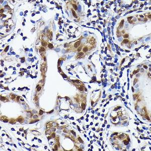 Immunohistochemistry analysis of paraffin-embedded human breast cancer tissue using Anti-Ubiquitin Antibody [ARC50024] (A307666) at a dilution of 1:100 (40X lens). Perform high pressure antigen retrieval with 10 mM citrate buffer pH 6.0 before commencing with IHC staining protocol