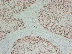 Immunohistochemical analysis of paraffin-embedded human Cervical squamous carcinoma using Anti-MCM2 Antibody