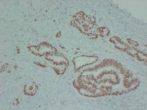 Immunohistochemical analysis of paraffin-embedded human Colon carcinoma using Anti-MCM2 Antibody