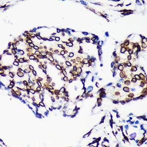 Immunohistochemistry analysis of paraffin-embedded human breast cancer tissue using Anti-Lamin A Antibody [ARC5001-08] (A308800) at a dilution of 1:200 (40x lens) Perform microwave antigen retrieval with 10 mM PBS buffer pH 72 before commencing with IHC staining protocol