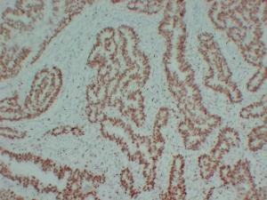 Immunohistochemical analysis of paraffin-embedded human Colon carcinoma using Anti-MCM2 Antibody